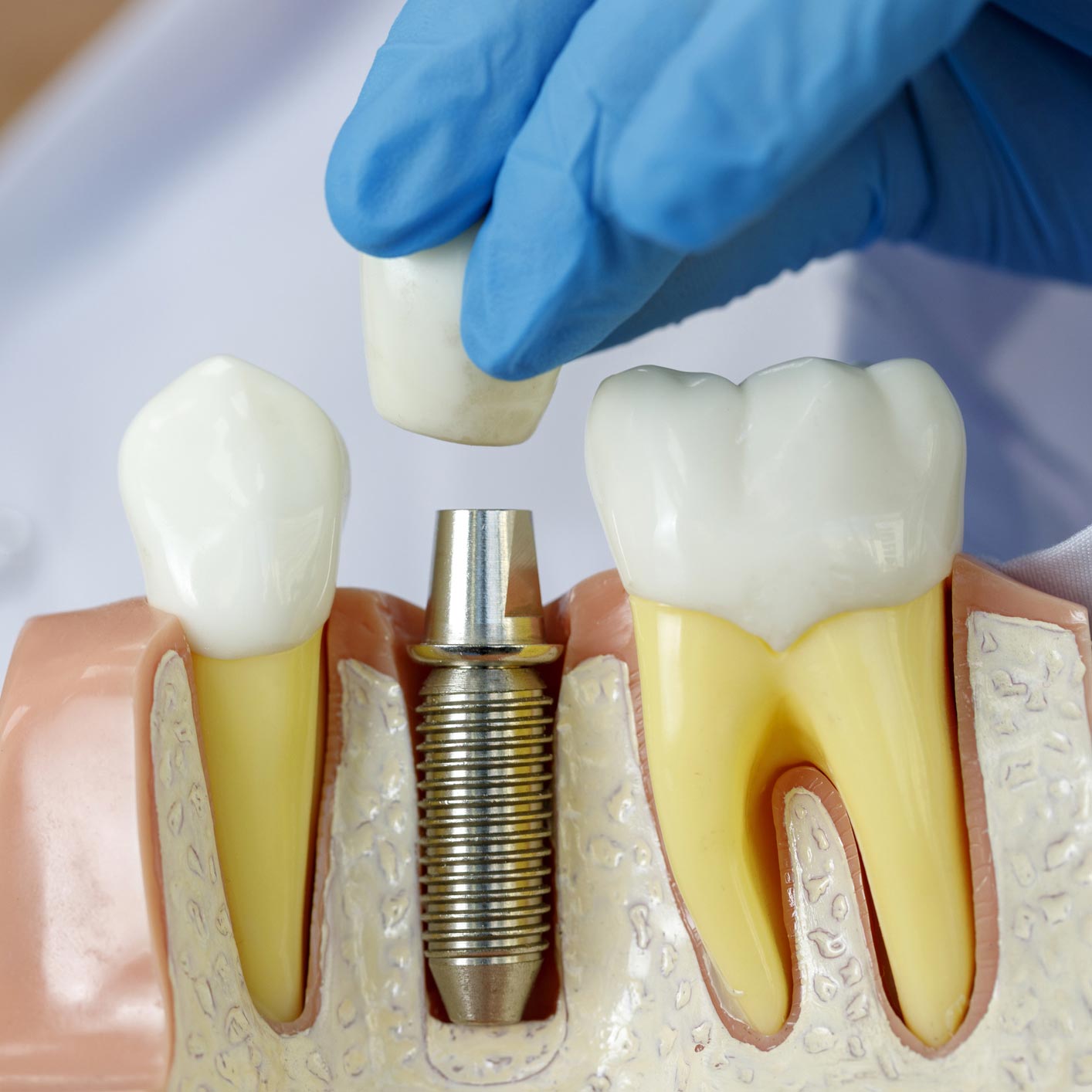 Implant dentaire : est-ce intéressant ?